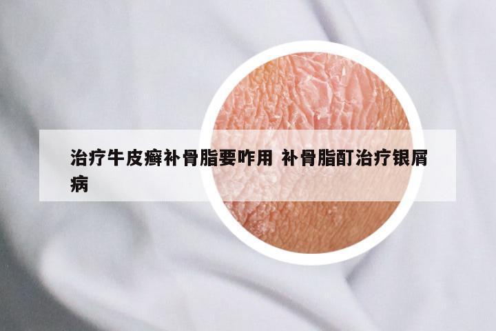 治疗牛皮癣补骨脂要咋用 补骨脂酊治疗银屑病