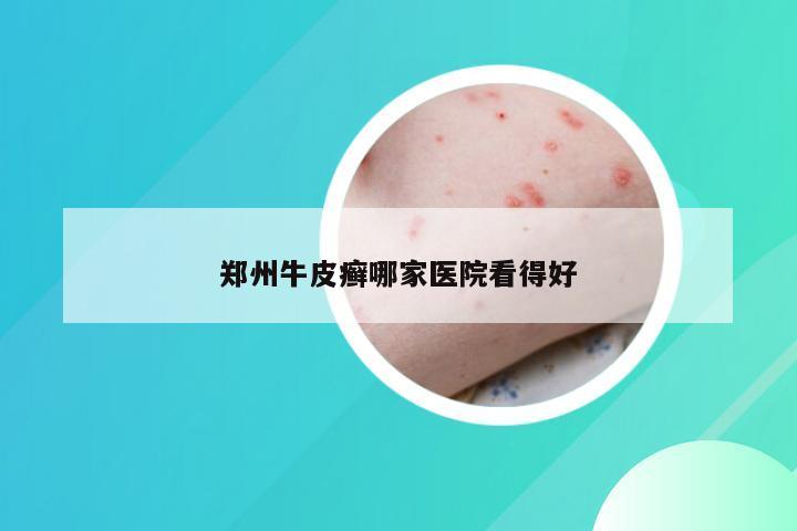 郑州牛皮癣哪家医院看得好