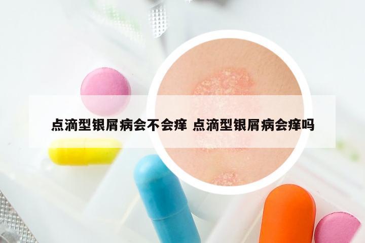 点滴型银屑病会不会痒 点滴型银屑病会痒吗