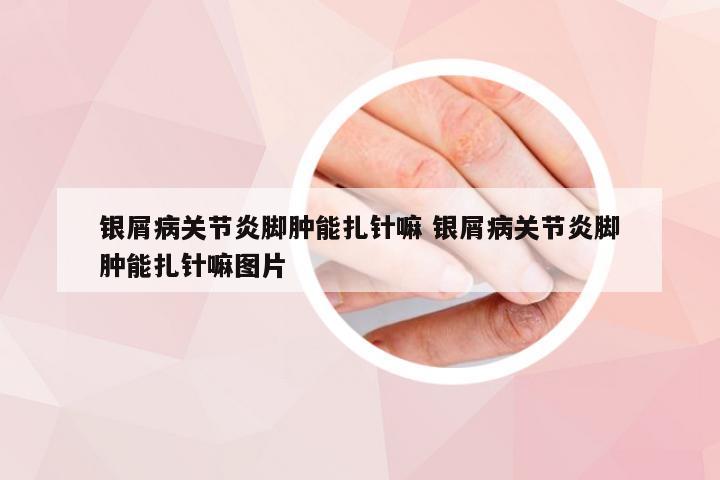 银屑病关节炎脚肿能扎针嘛 银屑病关节炎脚肿能扎针嘛图片