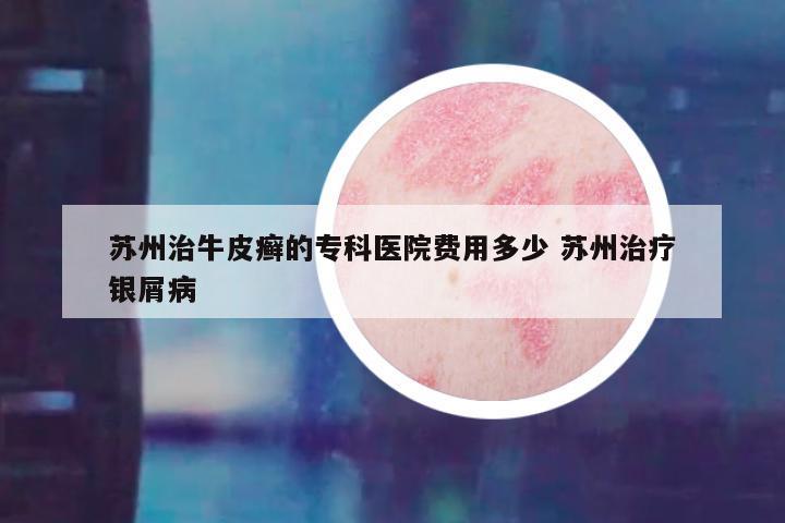 苏州治牛皮癣的专科医院费用多少 苏州治疗银屑病