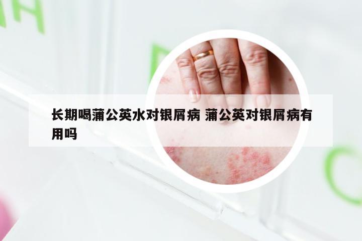 长期喝蒲公英水对银屑病 蒲公英对银屑病有用吗
