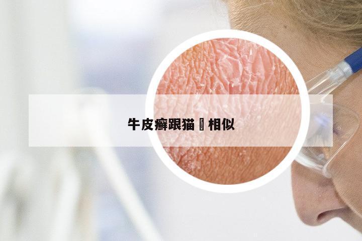 牛皮癣跟猫廯相似