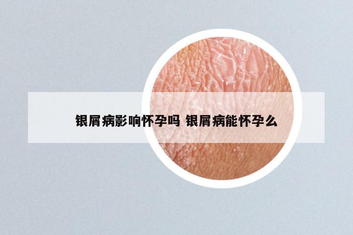 银屑病影响怀孕吗 银屑病能怀孕么