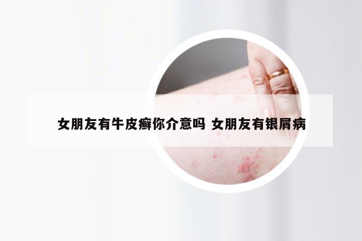 女朋友有牛皮癣你介意吗 女朋友有银屑病