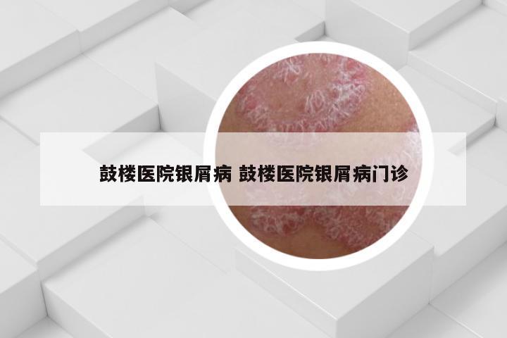 鼓楼医院银屑病 鼓楼医院银屑病门诊