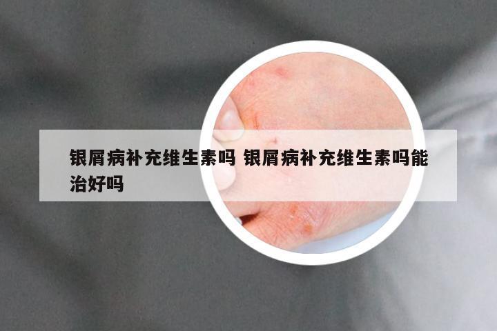 银屑病补充维生素吗 银屑病补充维生素吗能治好吗