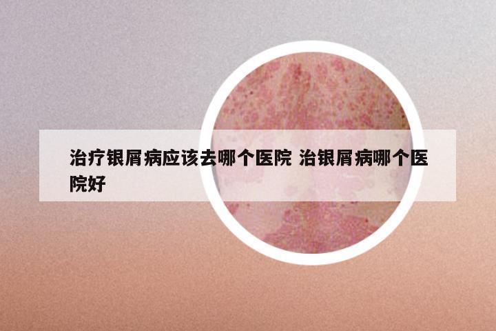 治疗银屑病应该去哪个医院 治银屑病哪个医院好