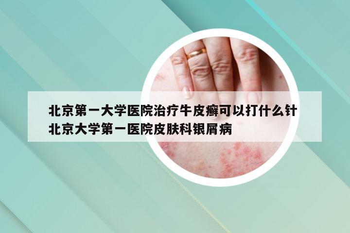 北京第一大学医院治疗牛皮癣可以打什么针 北京大学第一医院皮肤科银屑病