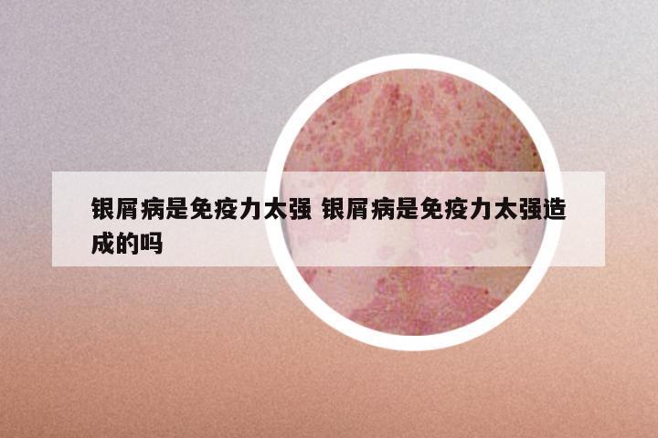 银屑病是免疫力太强 银屑病是免疫力太强造成的吗