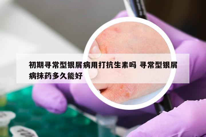 初期寻常型银屑病用打抗生素吗 寻常型银屑病抹药多久能好