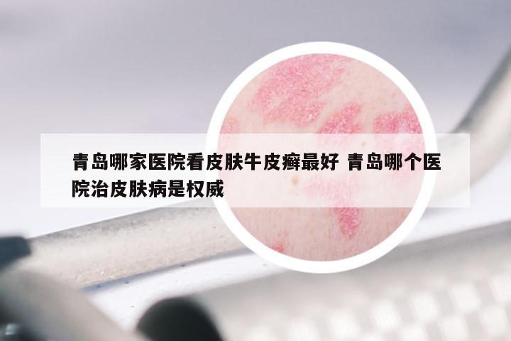 青岛哪家医院看皮肤牛皮癣最好 青岛哪个医院治皮肤病是权威