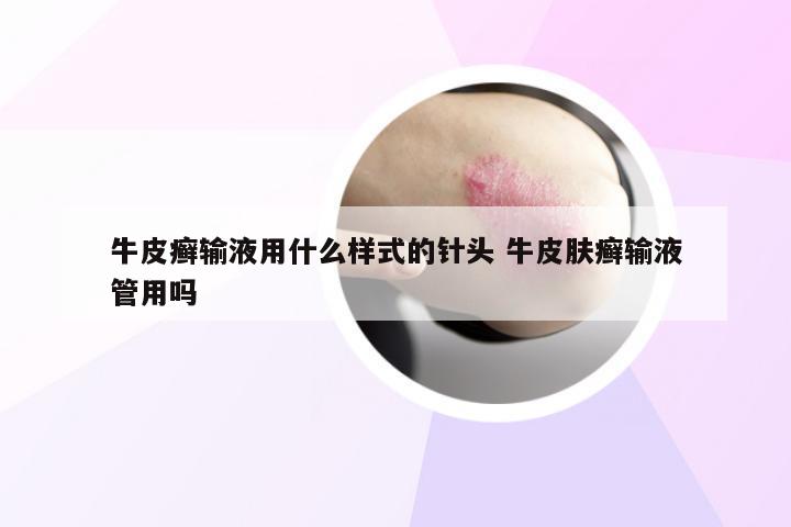 牛皮癣输液用什么样式的针头 牛皮肤癣输液管用吗