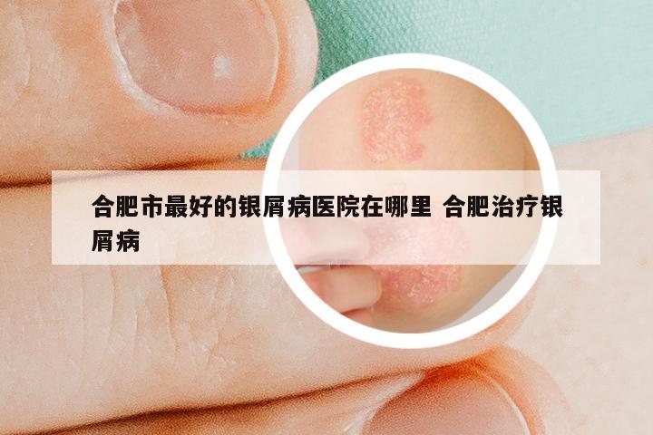 合肥市最好的银屑病医院在哪里 合肥治疗银屑病