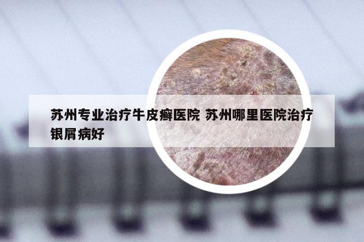 苏州专业治疗牛皮癣医院 苏州哪里医院治疗银屑病好