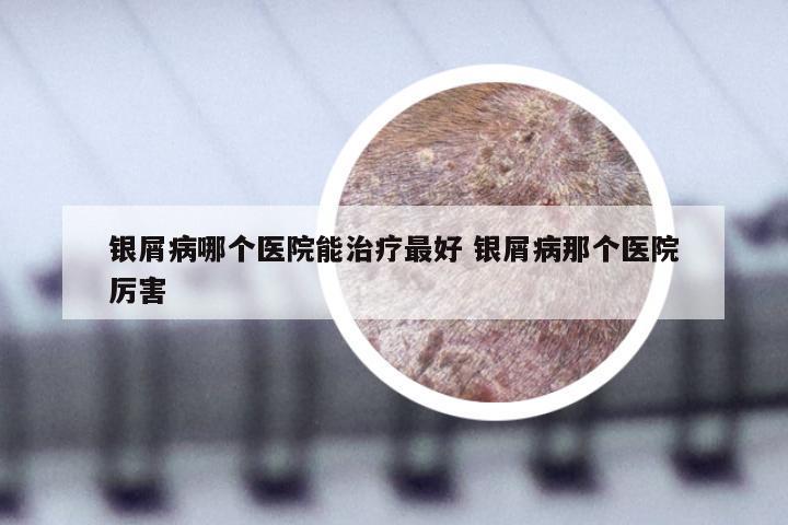 银屑病哪个医院能治疗最好 银屑病那个医院厉害