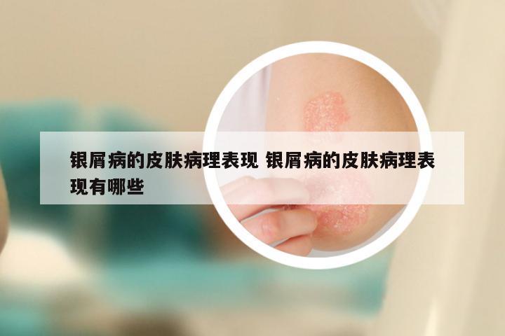 银屑病的皮肤病理表现 银屑病的皮肤病理表现有哪些