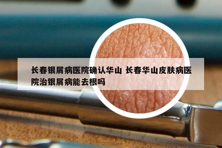 长春银屑病医院确认华山 长春华山皮肤病医院治银屑病能去根吗