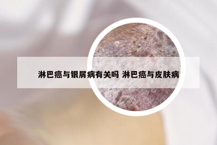 淋巴癌与银屑病有关吗 淋巴癌与皮肤病