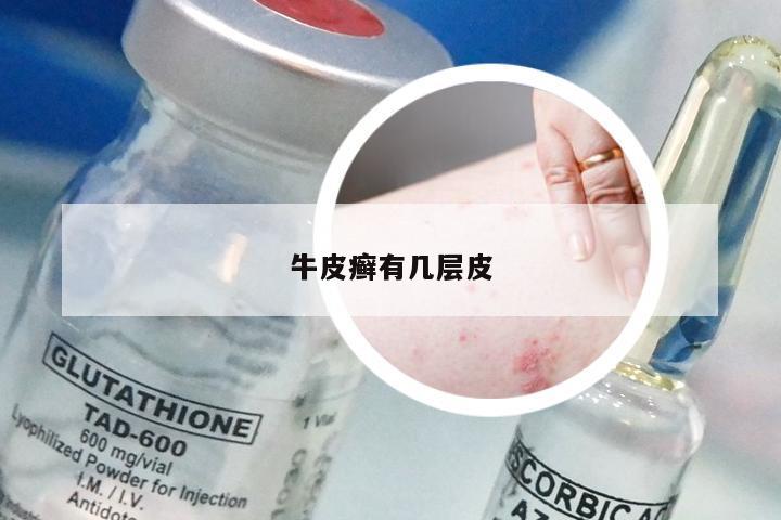 牛皮癣有几层皮