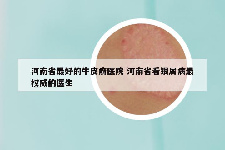 河南省最好的牛皮癣医院 河南省看银屑病最权威的医生