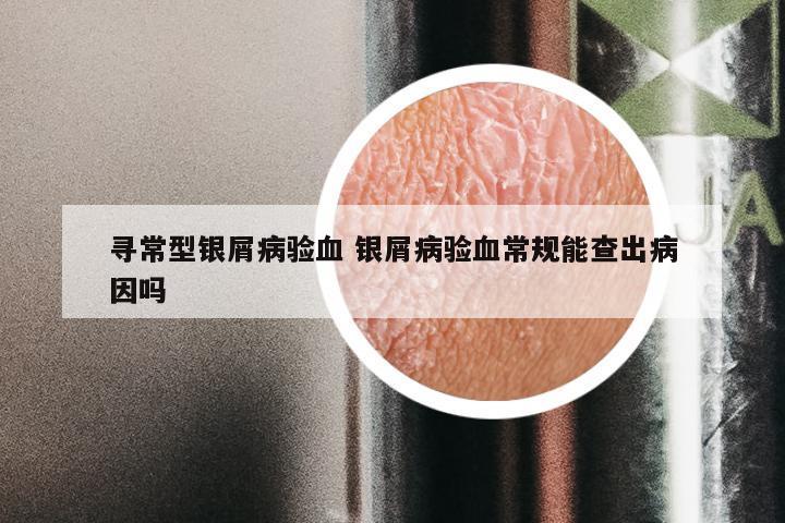 寻常型银屑病验血 银屑病验血常规能查出病因吗