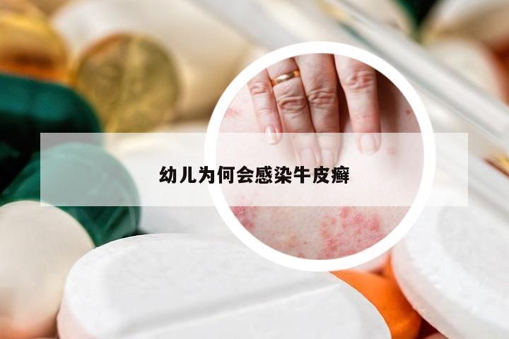 幼儿为何会感染牛皮癣