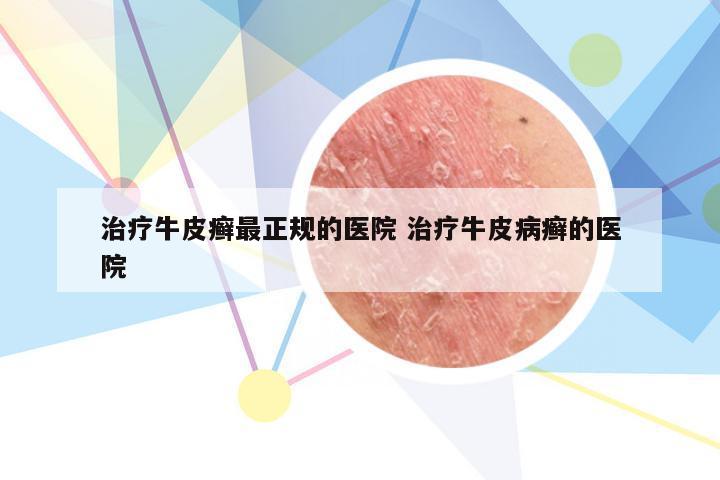 治疗牛皮癣最正规的医院 治疗牛皮病癣的医院