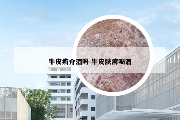 牛皮癣介酒吗 牛皮肤癣喝酒