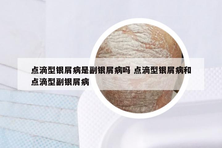 点滴型银屑病是副银屑病吗 点滴型银屑病和点滴型副银屑病
