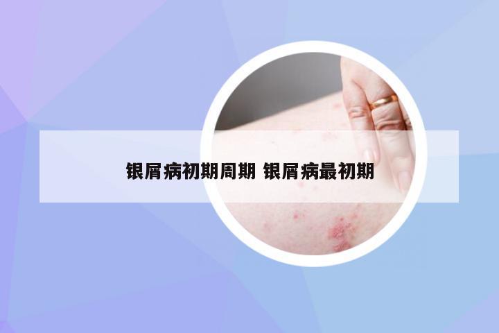 银屑病初期周期 银屑病最初期