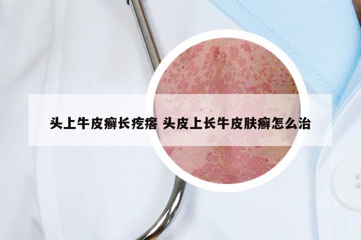 头上牛皮癣长疙瘩 头皮上长牛皮肤癣怎么治