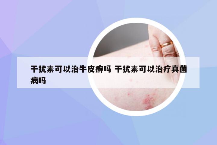 干扰素可以治牛皮癣吗 干扰素可以治疗真菌病吗