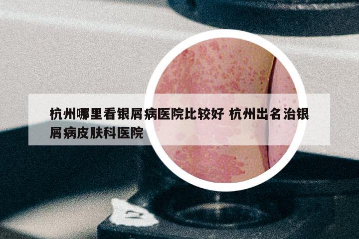 杭州哪里看银屑病医院比较好 杭州出名治银屑病皮肤科医院