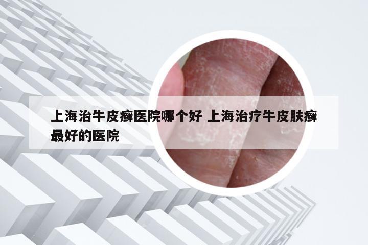上海治牛皮癣医院哪个好 上海治疗牛皮肤癣最好的医院