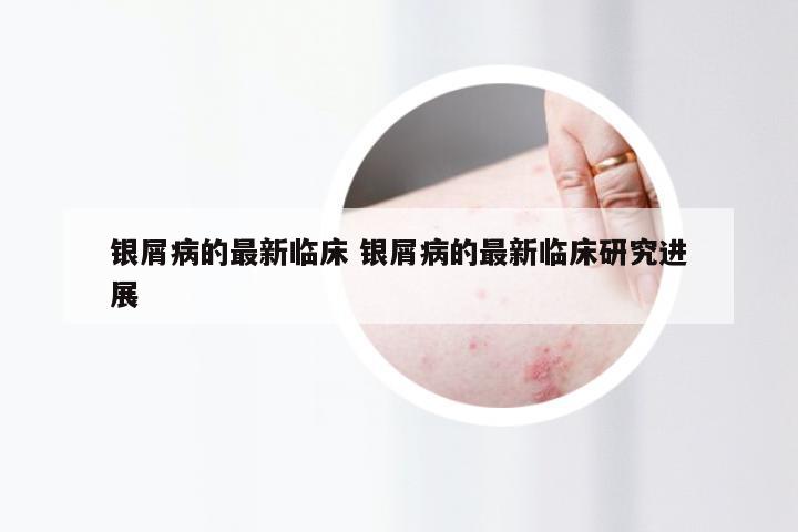 银屑病的最新临床 银屑病的最新临床研究进展