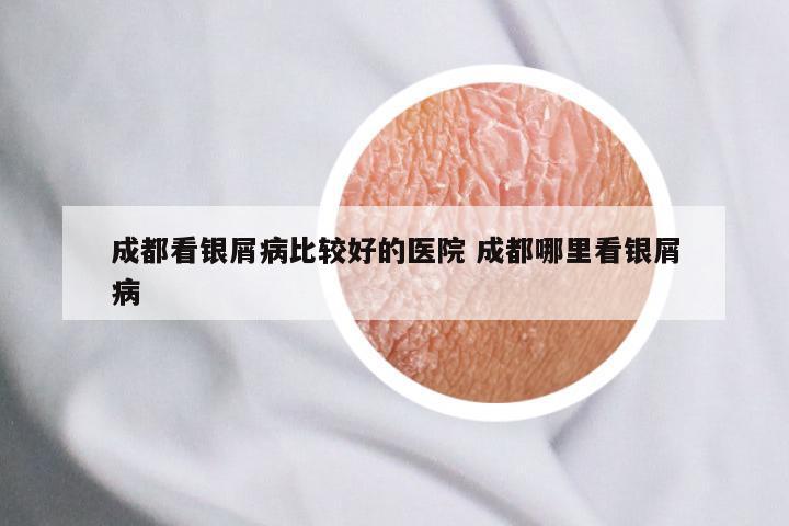 成都看银屑病比较好的医院 成都哪里看银屑病