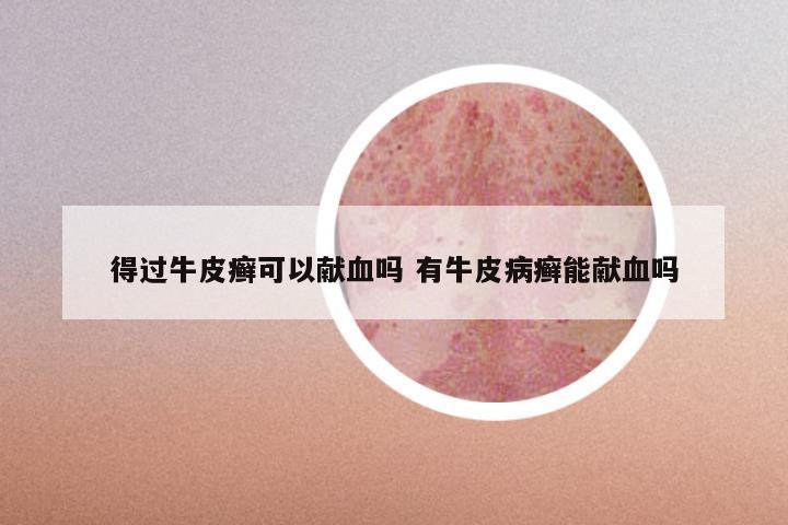 得过牛皮癣可以献血吗 有牛皮病癣能献血吗