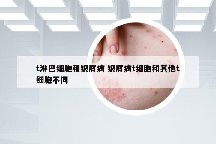 t淋巴细胞和银屑病 银屑病t细胞和其他t细胞不同