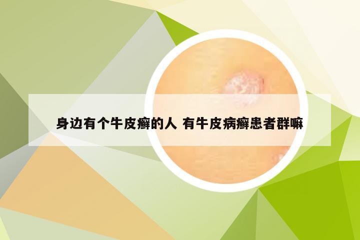 身边有个牛皮癣的人 有牛皮病癣患者群嘛
