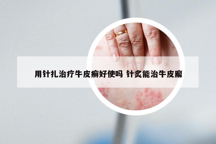 用针扎治疗牛皮癣好使吗 针炙能治牛皮廨