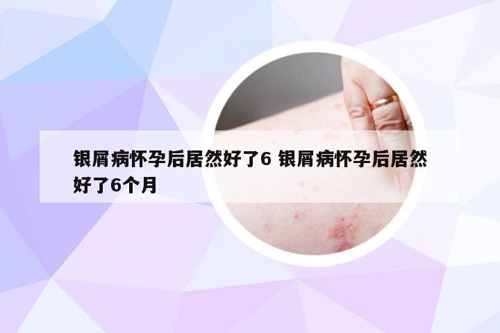 银屑病怀孕后居然好了6 银屑病怀孕后居然好了6个月