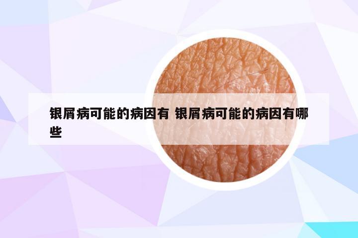 银屑病可能的病因有 银屑病可能的病因有哪些