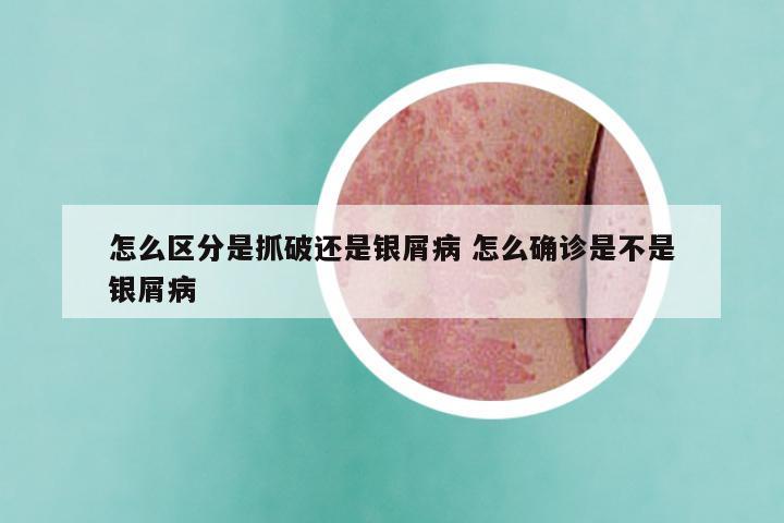 怎么区分是抓破还是银屑病 怎么确诊是不是银屑病