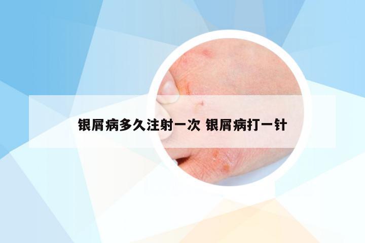 银屑病多久注射一次 银屑病打一针