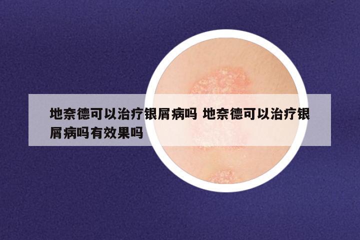 地奈德可以治疗银屑病吗 地奈德可以治疗银屑病吗有效果吗