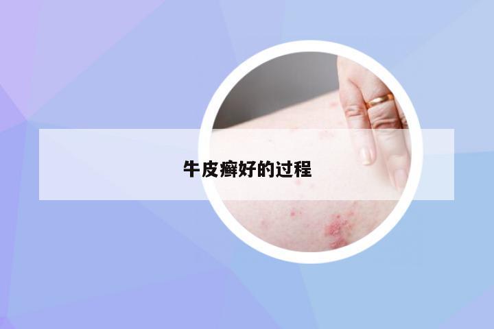 牛皮癣好的过程
