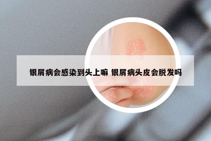 银屑病会感染到头上嘛 银屑病头皮会脱发吗