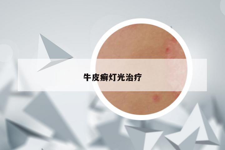 牛皮癣灯光治疗