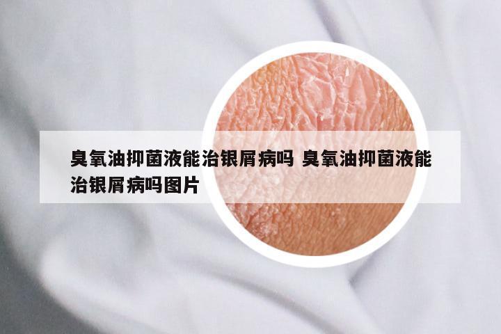 臭氧油抑菌液能治银屑病吗 臭氧油抑菌液能治银屑病吗图片